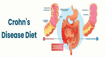 Crohn's Disease Diet: Which Foods Should You Avoid?