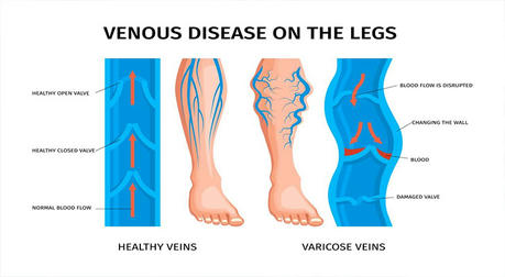 Understanding Varicose Veins